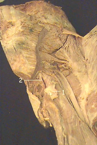 dissection of gluteal region to show course of the pudendal nerve