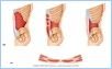 10-11_MuscAbdomWall_2_UN