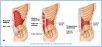 10-11bAbdomWall_L