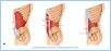 10-11bAbdomWall_LE