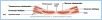 10-11cAbdomWall_L