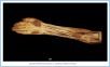 10_37aBA_ForearmWrist_AUN