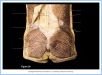 10_39BA_GlutealRegion_ALE