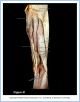 10_41BA_UpperThigh_ALE